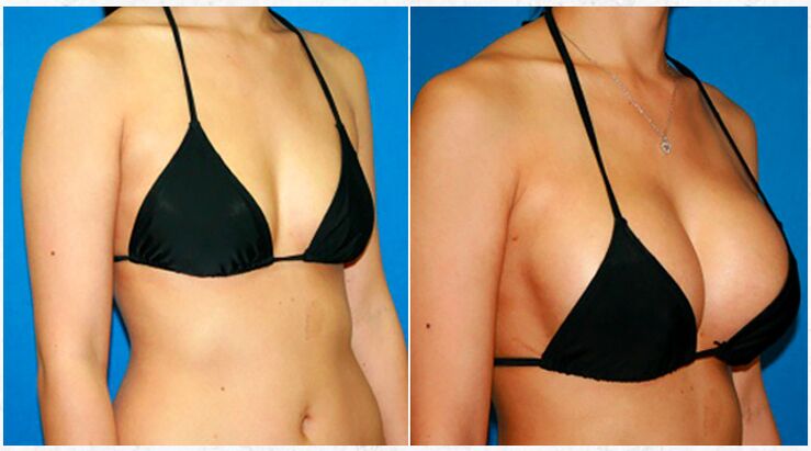Prije i poslije plastične operacije povećanja grudi