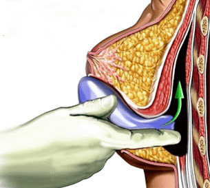 implantacija za povećanje grudi