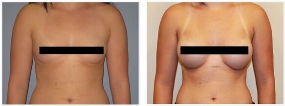 dojke prije i nakon operacije