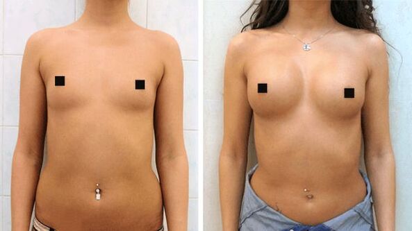fotografije prije i nakon kirurškog povećanja grudi