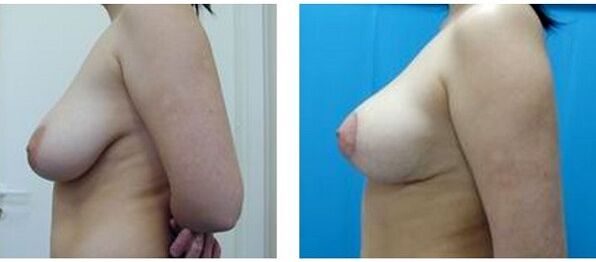 prije i poslije kirurškog povećanja grudi