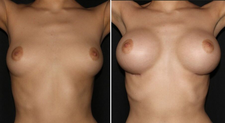 Prije i poslije operacije povećanja grudi